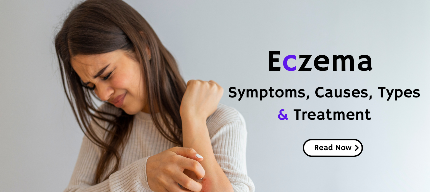 Eczema: What It Is, Symptoms, Causes, Types & Treatment